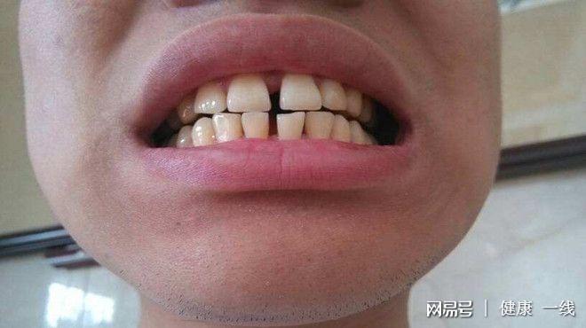 牙齿的缝隙为何会变大？这是真的吗？