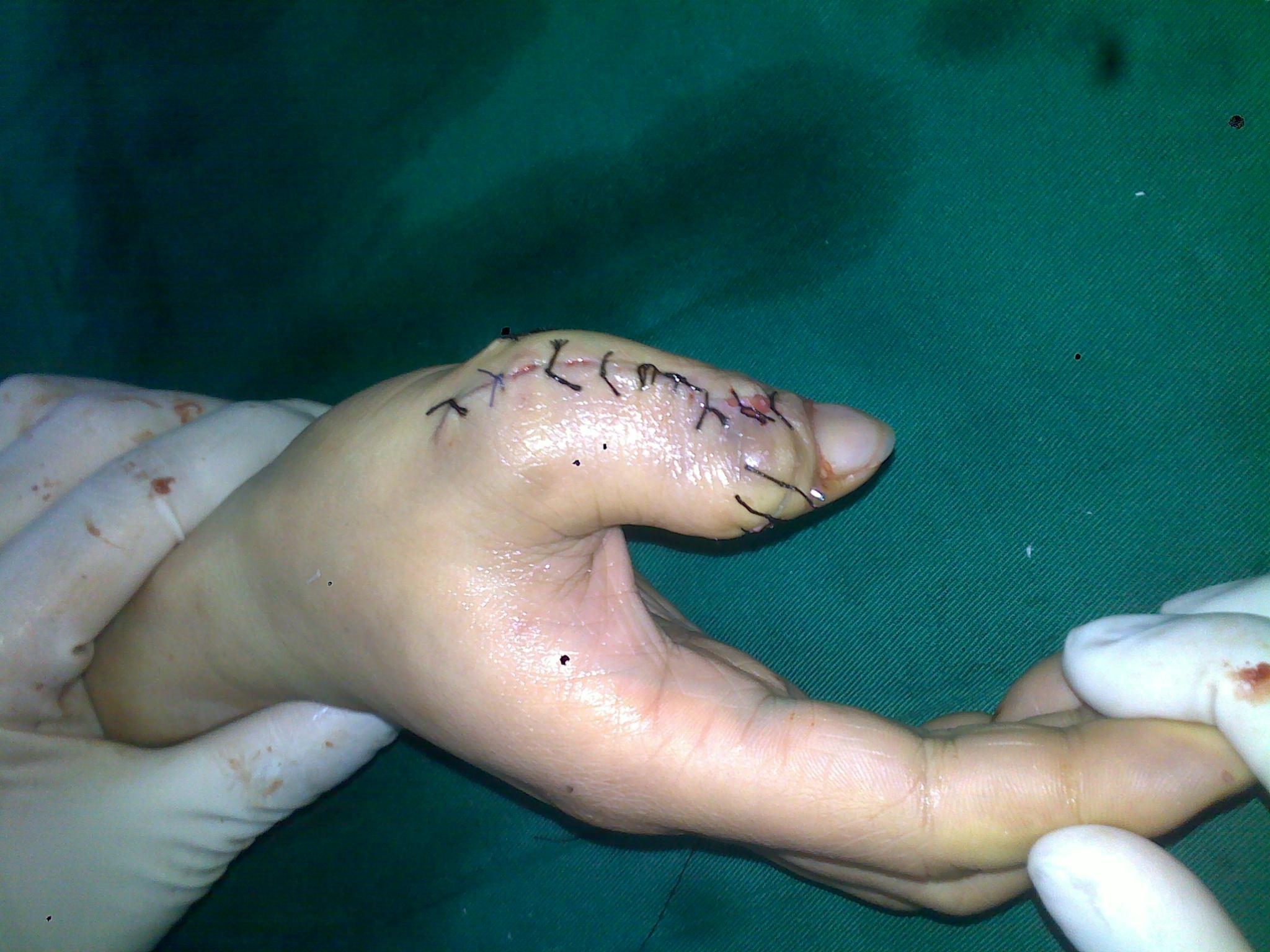 手指关节粗大整形手术图片